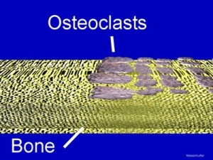 Osteoclasts on DrNevilleWilson pic from cdaarthritis